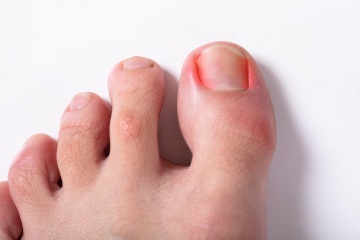 Ingrown toe nail and nail surgery Nowra